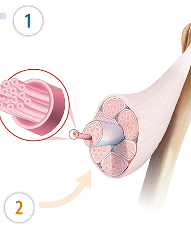 Ekyflex Tendon Evo